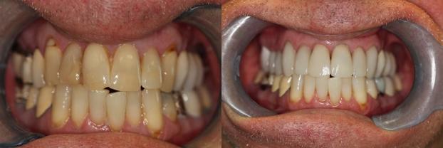 A happy customer of Malo Dental Prosthodontics
