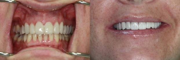 A happy customer of Malo Dental Prosthodontics