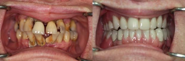 A happy customer of Malo Dental Prosthodontics
