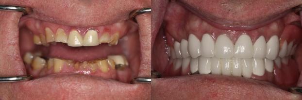 A happy customer of Malo Dental Prosthodontics