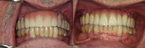 A happy customer of Malo Dental Prosthodontics