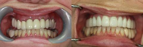 A happy customer of Malo Dental Prosthodontics