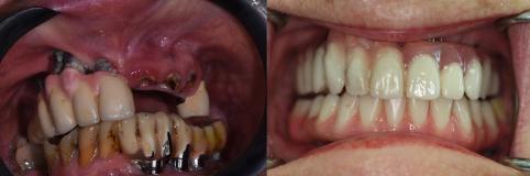 A happy customer of Malo Dental Prosthodontics